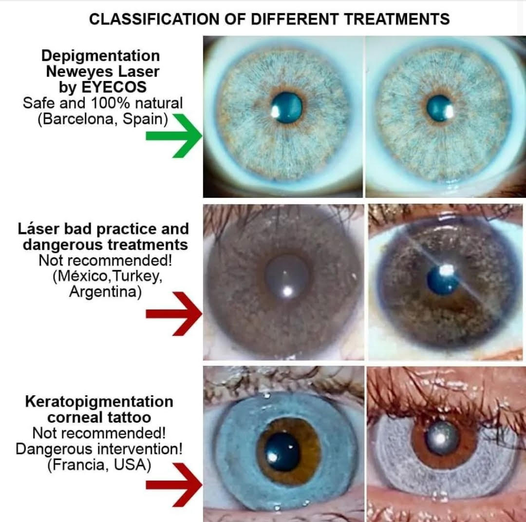 Cambio de color de ojos Despigmentación láser versus